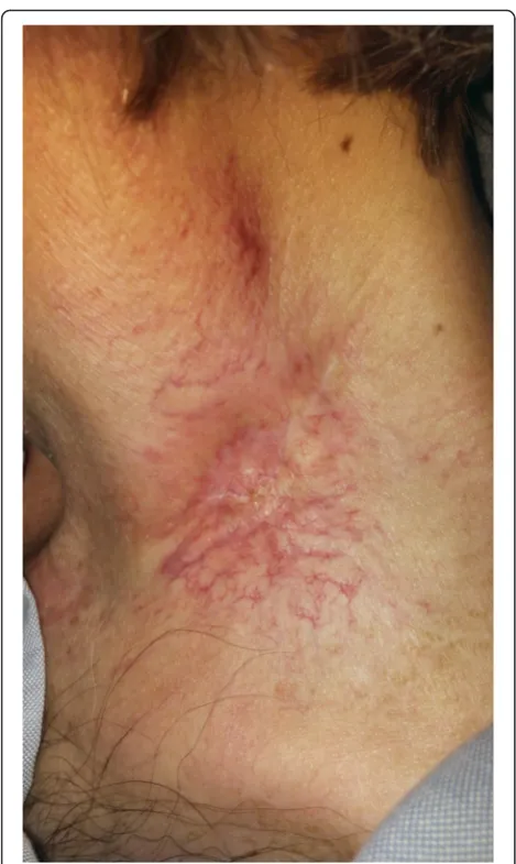 Fig. 7 Resolution of left low neck wound afterxanthogranuloma resection