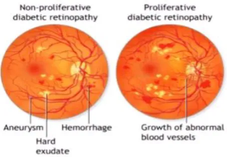 Figure 1: Non-proliferative and Proliferative 
