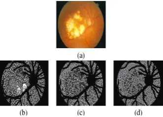 Figure 5: Feature extraction using P = 8 and R = 5. (a) AMD fundus image,(b-d) LBP images calculated on R , G and B components, respectively