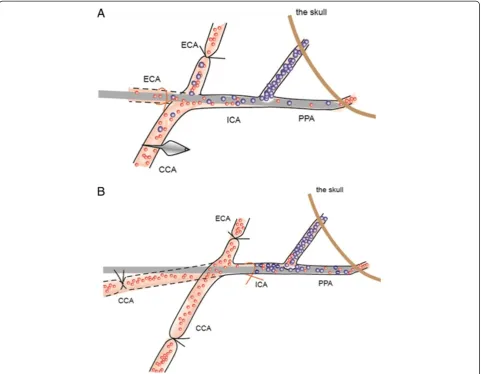 Figure 2 Two insertion routes of the ICA injection needle are shown. (A) Insertion of the ICA injection needle into the internal carotid artery(ICA) via the external carotid artery (ECA) stump