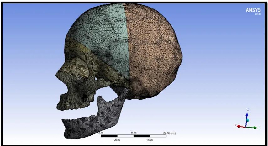 Figure 53 :3 D model with miniplates placed in maxilla and mandible 