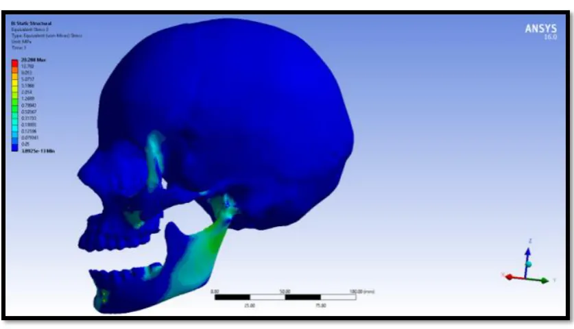 Figure 60:Force-6N- Von Mises stress of 1.5mm implant diameter of 1 mm pitch     