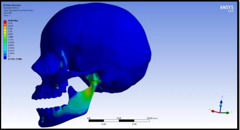 Figure 63: Force- 4N- Von Mises stress of 1.5mm implant diameter of 1.5 mm pitch 