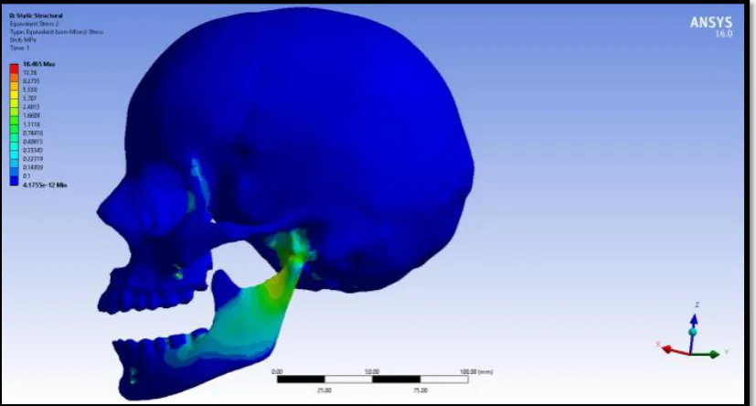 Figure 67: Force- 4N- Von Mises stress of 2mm implant diameter of 0.5 mm pitch 