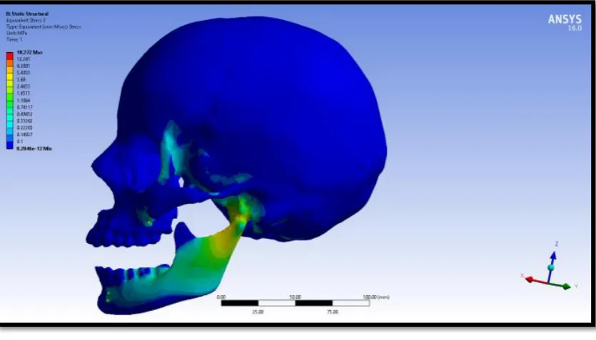 Figure 69: Force- 8N- Von Mises stress of 2mm implant diameter of 0.5 mm pitch 