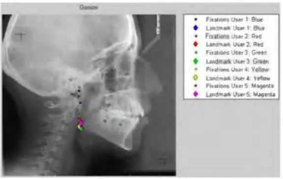 Figure 2.1 Fixations point for the five subjects to locate Gonion  