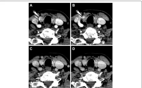 Fig. 1 Typical perfusion characteristics in an intrathyroidal parathyroid adenoma. 70 keV VMIs at (a, b) 25 s and (c, d) 55 s are shown of asurgically and pathologically proven intrathyroidal parathyroid adenoma (large arrow)
