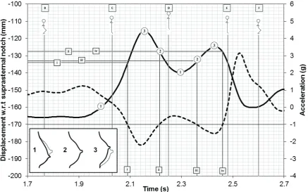 Table 1: Neutral position where breast accelerations reached -1 g at the four points in time (Figure 2: i - iv)