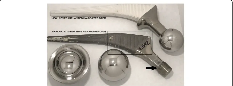 Fig. 1 Example case of progressive radiolucency around a Corail stem with a metal-on-metal bearing over a period of 4 years