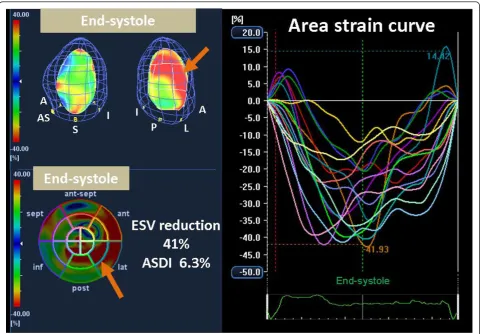 Figure 3 Color-coded 3-D LV displaysitesdelayed peak strain in lateral segments (orange arrow) (top left) and bull’s-eye plot image (bottom left) and corresponding area strain curves from 16 LV (right) for a responder, demonstrating dyssynchronous strain c