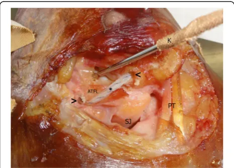 Fig. 1 Example of suture tape reconstruction after dissection of ananterior talofibular ligament (ATFL)