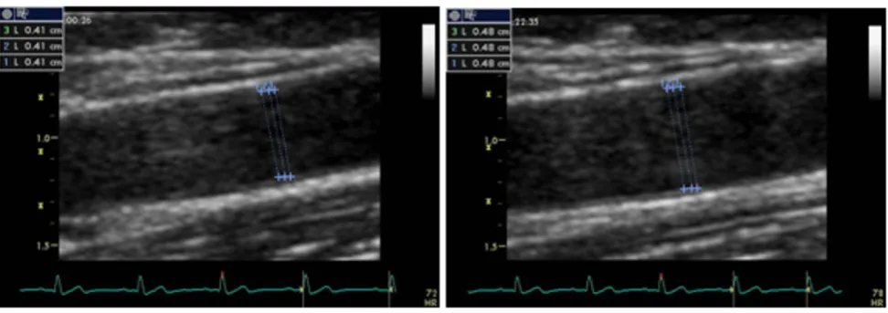Figure 1Two-dimensional images of the brachial artery in a case with preserved endothelium dependent flow mediated dilationTwo-dimensional images of the brachial artery in a case with preserved endothelium dependent flow medi-ated dilation