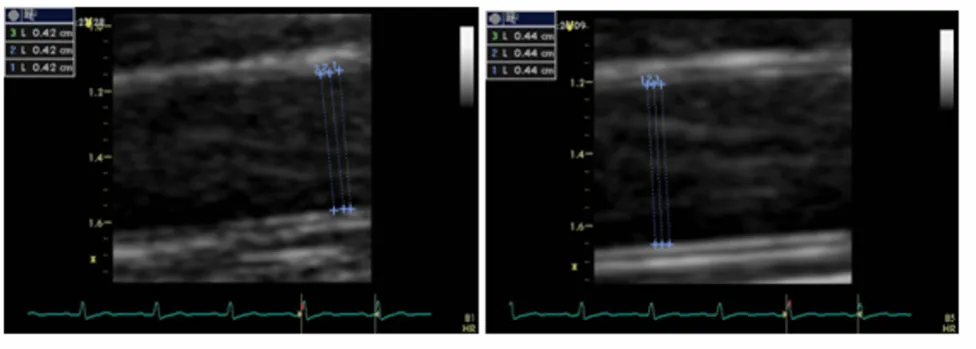 Figure 2Two-dimensional images of the brachial artery in a case with impaired endothelium dependent flow mediated dilationTwo-dimensional images of the brachial artery in a case with impaired endothelium dependent flow mediated dilation