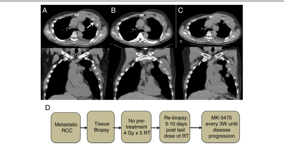 Fig. 2 CT scans of the patient demonstrate disease progression. a Axial and coronal CT images taken before treatment