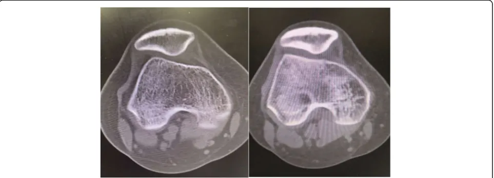 Fig. 3 Preoperative CT and X-ray images show patellofemoral instability and femoral trochlear dysplasia