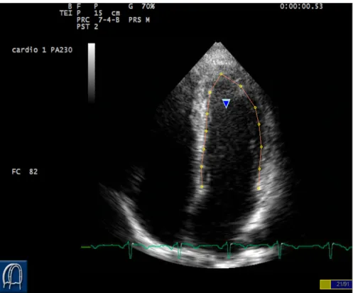 Figure 2Points positioningPoints positioning. Selection of 13 equidistant points dividing the left ventricle in segments according to a 6 segments model.