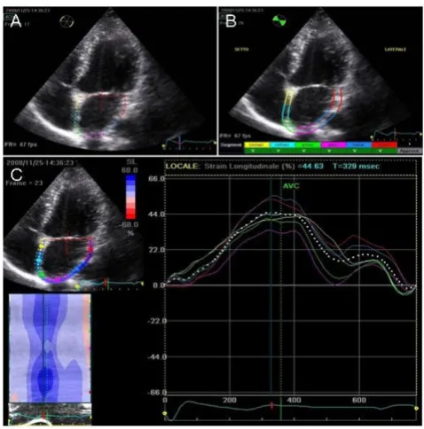 Figure 1trackingMeasurement of left atrial longitudinal strain by speckle Measurement of left atrial longitudinal strain by speckle tracking