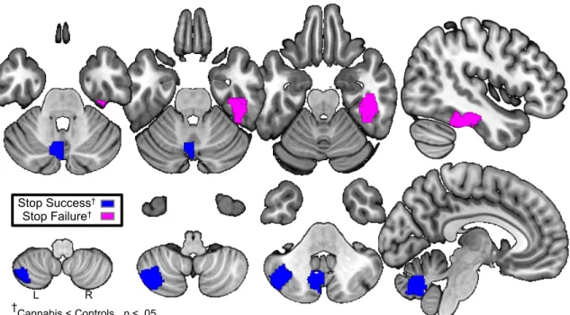Figure 2.3.3: Lower activation in three regions predicts cannabis use by age 16 in males