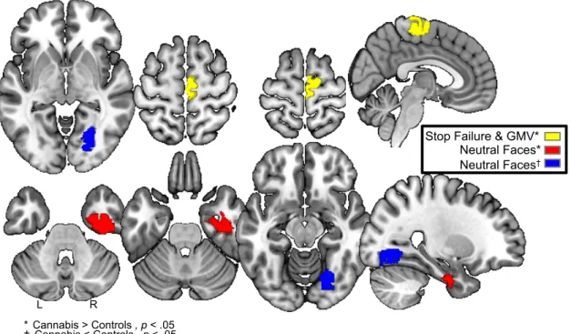 Figure 2.3.4: Activations and structural differences in three regions predicts cannabis use  by age 16 in females