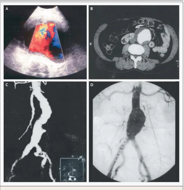 Figure 2. An Abdominal Aortic Aneurysm.