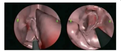 Figure 2 VR representation of sinonasal cavity. Views of anethmoidectomy (left) and sphenoidotomy (right) usingthe microdebrider.