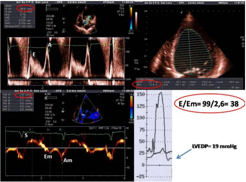 Figure 6tion (LVEF 31%; upper right panel)Example of non-invasive estimation of left ventricular filling pressures in a patient with severe systolic left ventricular dysfunc-Example of non-invasive estimation of left ventricular filling pressures in a pati