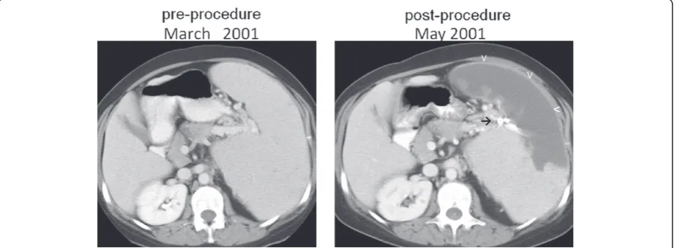 Figure 3 Patient 3, pre and post-procedure axial CT scans with contrast, demonstrating massive splenomegaly, the successfulplacement of radiopaque material in branches of the splenic artery (→), resulting in splenic infarction (v).