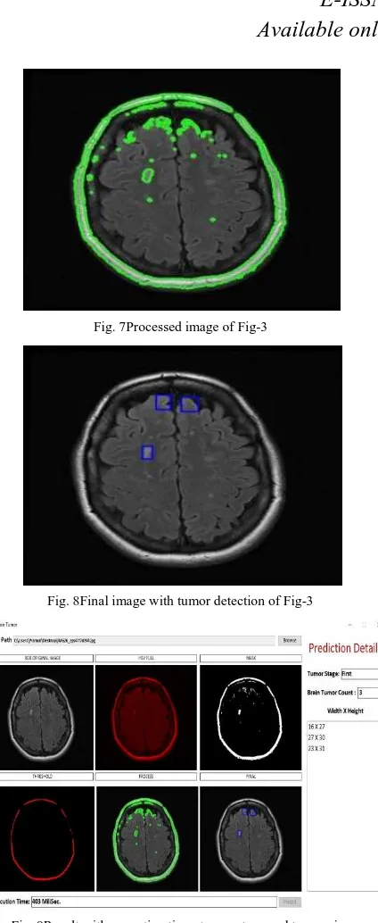 Fig. 8Final image with tumor detection of Fig-3 