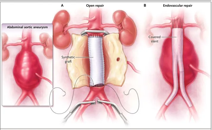 Figure 1. Techniques Available for Repair of Abdominal Aortic Aneurysms.