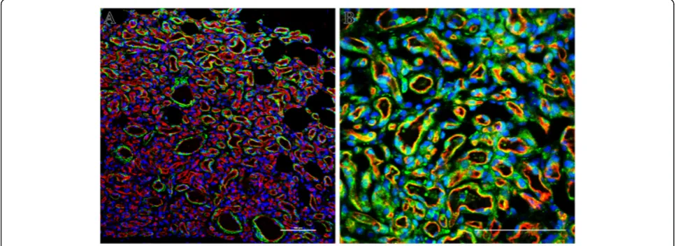 Figure 3 Double immunofluorescence staining of IH tissues. (A)(red), smooth muscle markerstained for CD31 (red), VEGF-A (green) and nuclei (blue) (fluorescent microscopy)