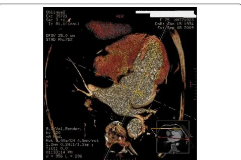 Figure 4 Detection by computed tomography of lipomatous hypertrophy of the interatrial septum.