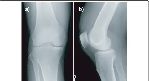 Figure 2 Computed tomography scans showing sagittal and coronal views of the knee: the displaced fragments of the posteriorintercondylar eminence (a) and the avulsed lateral tibial condyle (b) can be observed.