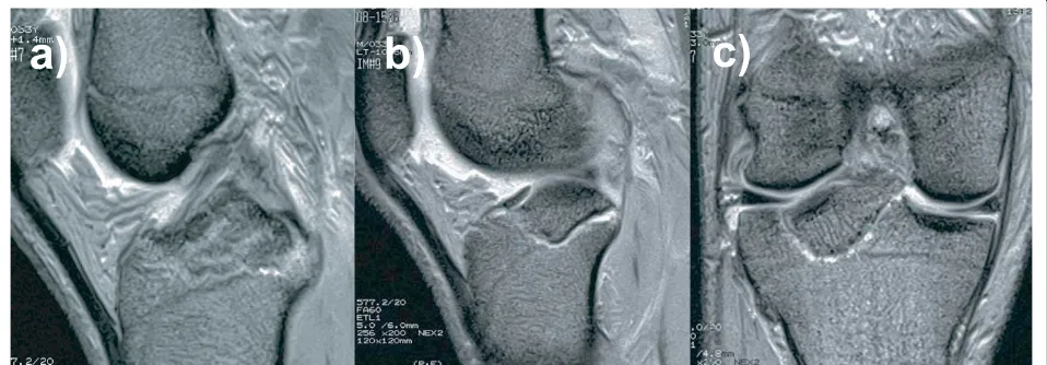 Figure 3 Computed tomography scans showing three-dimensional reconstruction views of the knee: the displacedfragments of the posterior intercondylar eminence and thelateral tibial condyle can be observed.