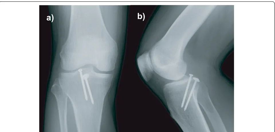 Figure 5 Radiographs (a and b) at the 3-month follow-up showing union of the bone fragments.