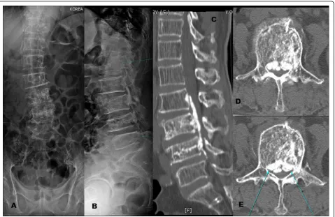 Figure 1 (A-B) shows post kyphoplasty radiogram of lumbar spine which did not clarify any idea about cement leakage; figure (C-E)shows that cement leakage spread along the posterior longitudinal ligament at L2-L4 levels causing severe compression of canal,possibly through pedicle violation.