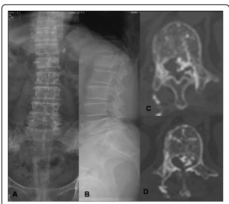 Figure 2 (A-C) shows laminectomy of L3-and L4 and partiallaminectomy of L2 performed to achieve decompression ofcord without any instrumentation