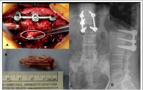 Figure 5 A shows intraoperative image that showed epidural cement leakage from pedicle violation; figure 5B showed completelyremoved cement mass of around 3.3 cm size and figure 5C-D shows postoperative radiogram of lumbar spine after decompressionand pedicle screw instrumentation followed by posterolateral fusion.