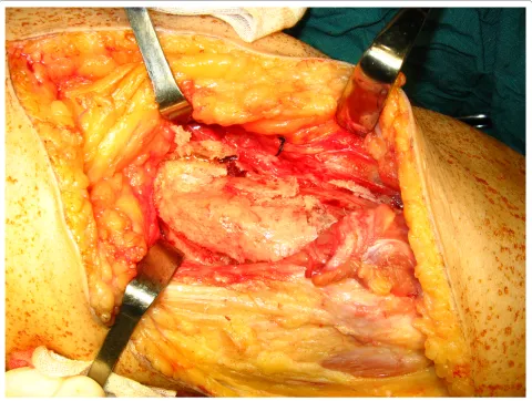 Figure 4 Gastrocnemius and the hamstrings were not involved in the heterotopic bone mass.