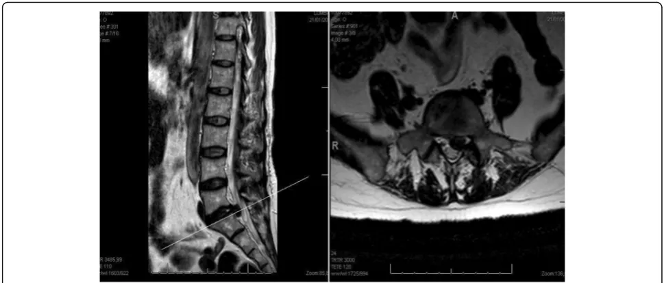 Fig. 2 Lumbar spine x ray ap view. L5-S1 Interspinous complication,open anchorage wing
