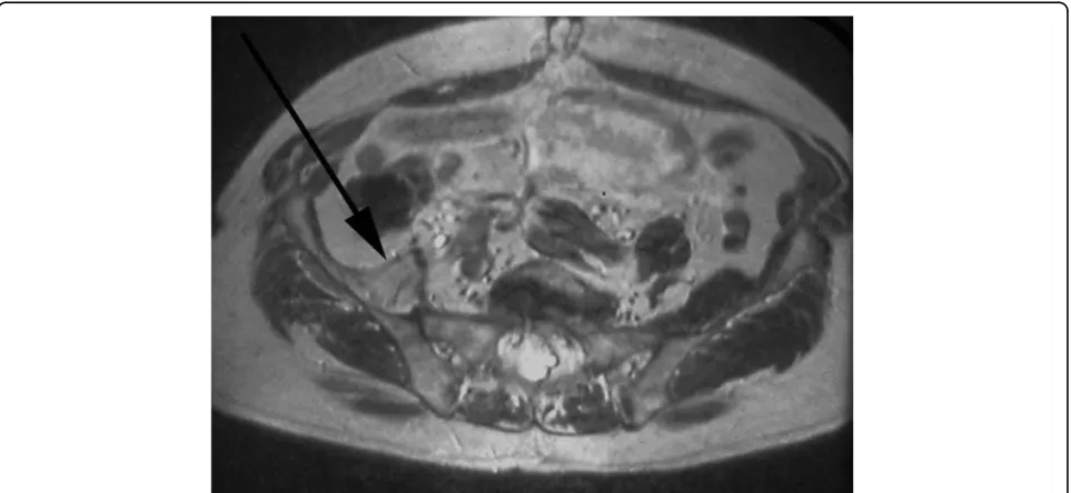 Figure 2 A coronal T1 MRI showing a normal ilio-psoas tendon on the left side (arrows) but its absence on the right side.