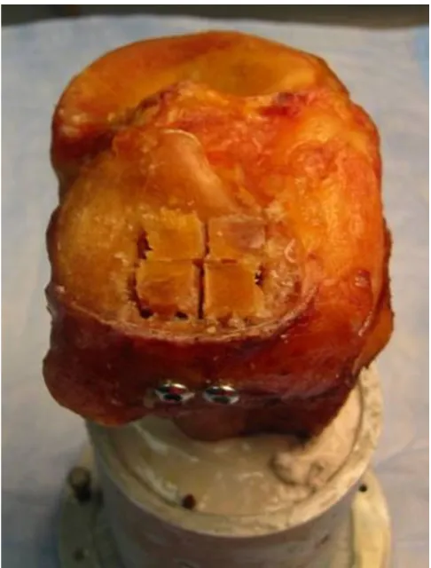Figure 3osteochondral fragmentsEnd result for both construct with anatomic reduction of the End result for both construct with anatomic reduc-tion of the osteochondral fragments.