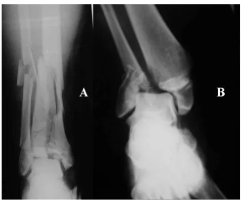 Figure 1torsional force (bimaleollar)(Pilon), (B) Intra-articular fracture of the ankle joint due to (A)