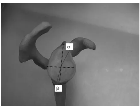 Figure 3upper posterior column of the scapula (Measure of the angle between the glenoid surface and the φ)