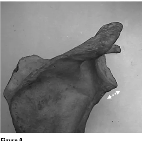 Table 1: 3-D CT and Specimen values of anterior and posterior glenoid neck length