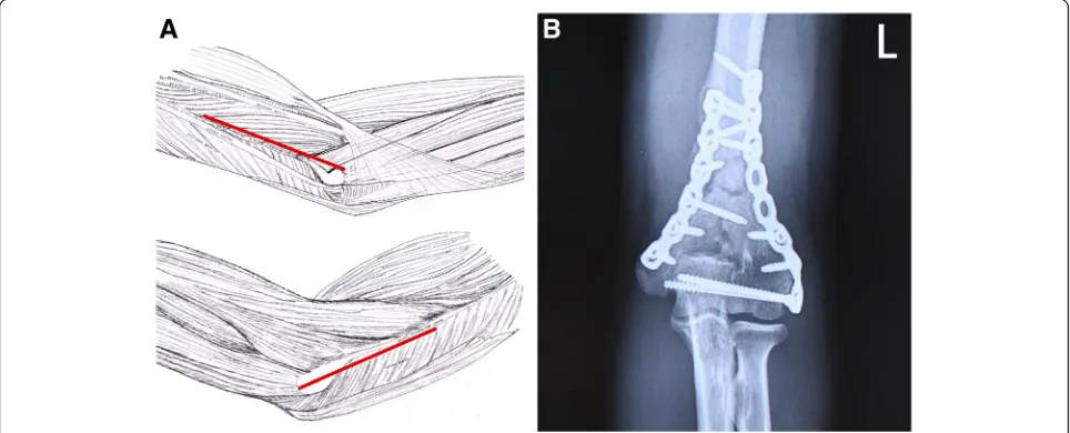 Fig. 1 a The combined medial and lateral approach. The upper figure shows the ulnar side view, and the lower the radial side view