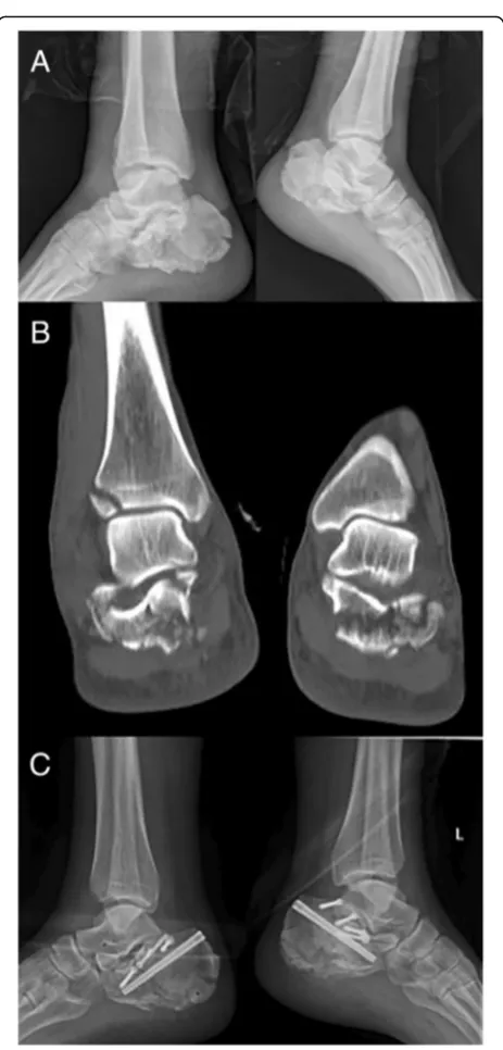 Fig. 3 Case 2: A 38-year-old male who was a smoker with bilateralcalcaneus fractures. X-ray lateral view (a) and CT scan (b) showingsevere compression of the subtalar joint articular surface