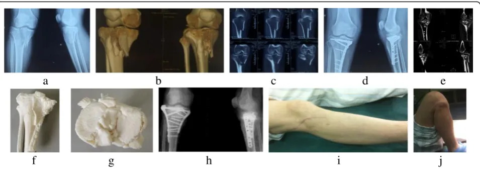 Fig. 1 A 54-year-old male patient sustained the tibial plateau fracture caused by bicycle accident (Schatzker V, AO/OTA 41.C1)