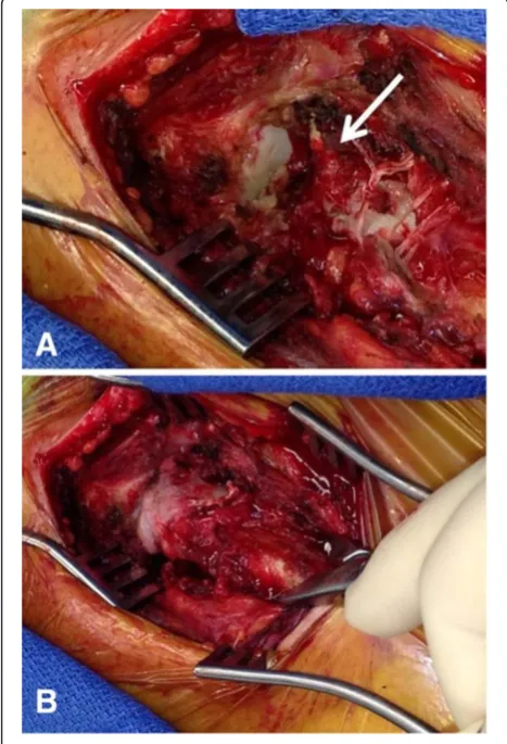 Figure 6 Bridge plating of the left sternoclavicular joint usinga 3.5 mm third-tubular locking plate