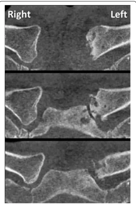 Figure 7 Follow-up CT scan at 9 months post injury (7 monthsafter hardware removal) demonstrates early posttraumaticarthritis of the left sternoclavicular joint, compared to thecontralateral (uninjured) right side.