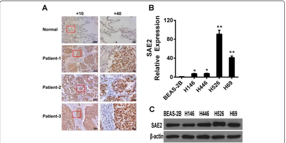 Fig. 1 SAE2 expression in SCLC tissues and cell lines. a Representative immunohistochemical results of the expression of SAE2 in tumor tissuesfrom SCLC patient (n = 20) and normal lung tissues (n = 5)